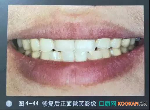 拍不好口腔照片怎么辦？這些口腔攝影方法與技巧請收好！